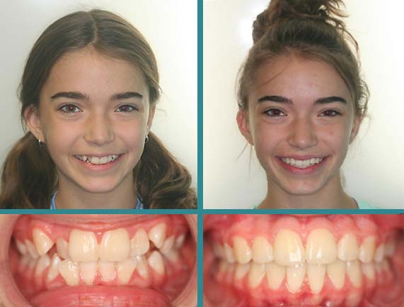 Before After Case at Orthodontic Specialist - 1
