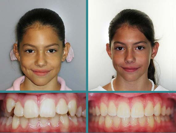 Before After Case at Orthodontic Specialist - 10