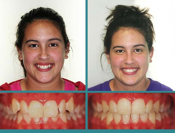 Before After Case at Orthodontic Specialist - 11