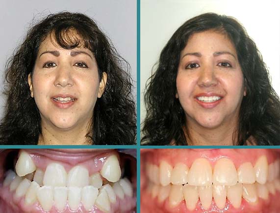 Before After Case at Orthodontic Specialist - 12