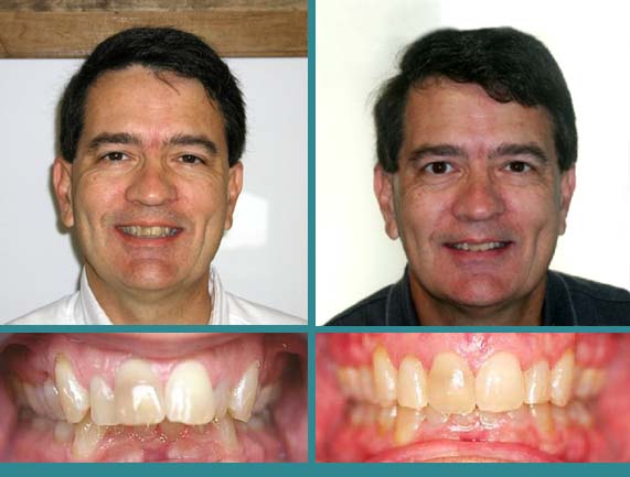 Before After Case at Orthodontic Specialist - 13