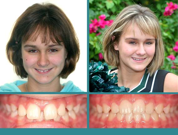 Before After Case at Orthodontic Specialist - 15