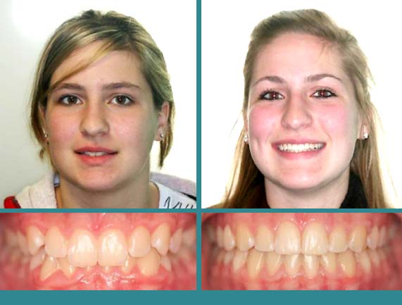Before After Case at Orthodontic Specialist - 16