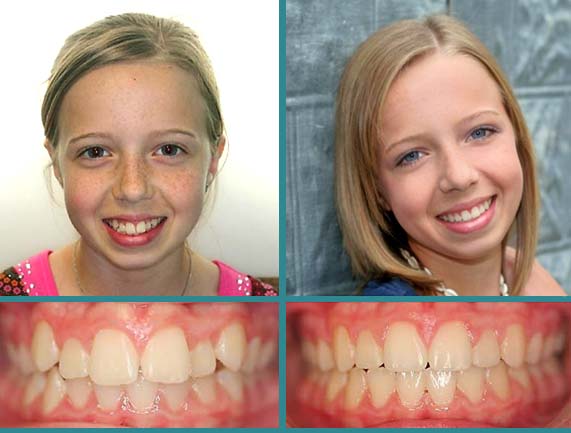 Before After Case at Orthodontic Specialist - 17