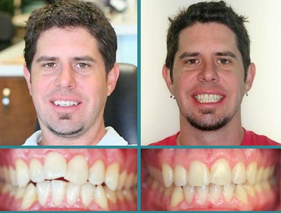 Before After Case at Orthodontic Specialist - 18