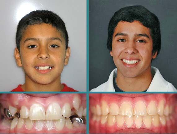 Before After Case at Orthodontic Specialist - 19