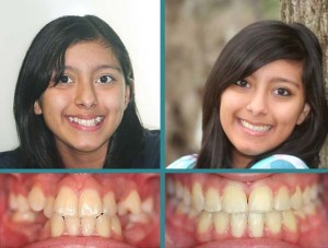Before After Case at Orthodontic Specialist - 2-2