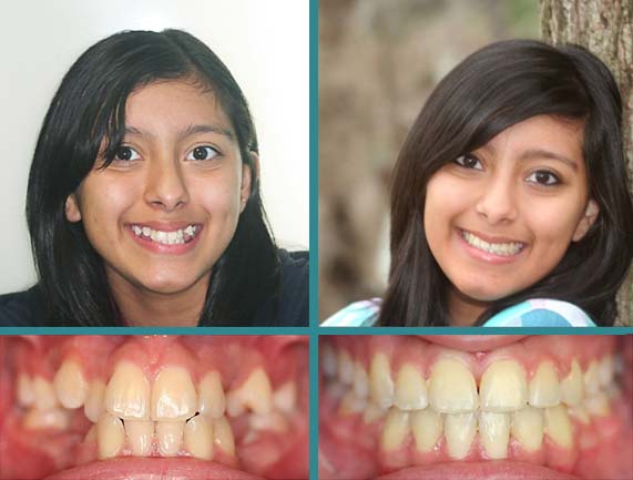 Before After Case at Orthodontic Specialist - 2