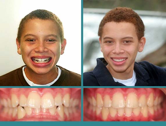 Before After Case at Orthodontic Specialist - 21