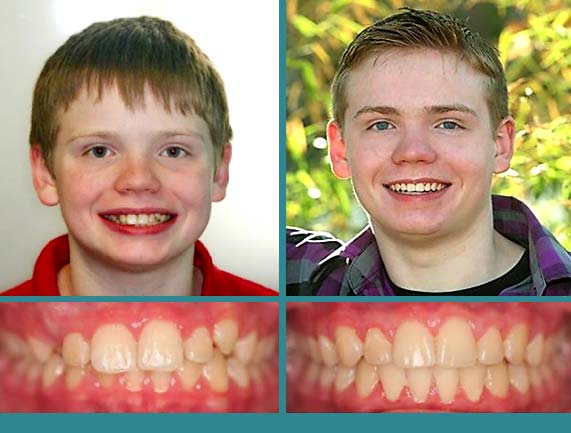 Before After Case at Orthodontic Specialist - 22