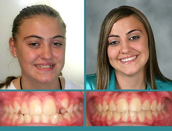 Before After Case at Orthodontic Specialist - 23