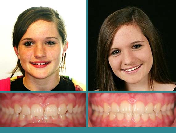 Before After Case at Orthodontic Specialist - 24