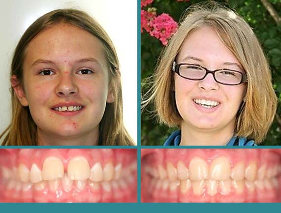 Before After Case at Orthodontic Specialist - 26