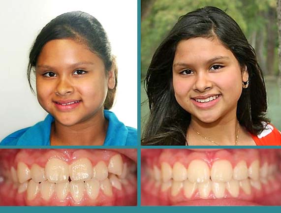 Before After Case at Orthodontic Specialist - 27
