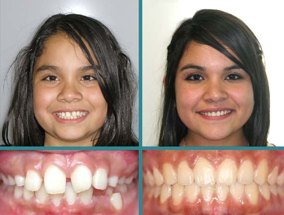 Before After Case at Orthodontic Specialist - 4