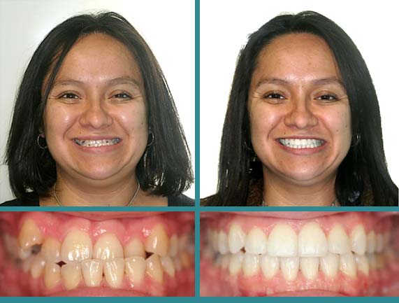 Before After Case at Orthodontic Specialist - 5