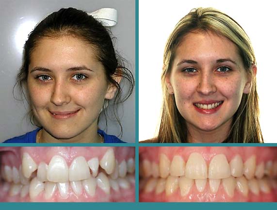 Before After Case at Orthodontic Specialist - 6