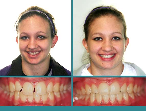 Before After Case at Orthodontic Specialist - 7
