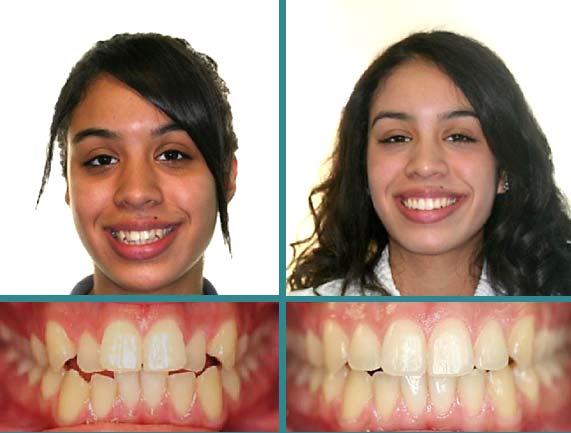 Before After Case at Orthodontic Specialist - 8
