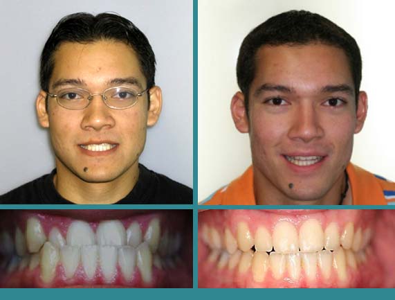 Before After Case at Orthodontic Specialist - 9